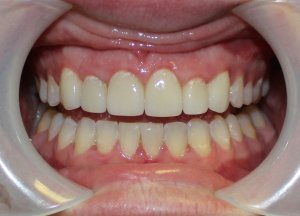 After photo: Patient mouth with whitened teeth of even size and shape in Mento OH