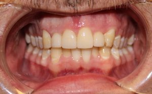 After photo: Dental crowns provide evenly-colored teeth in Mento OH