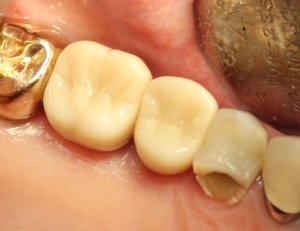 After photo: Final teeth replacement with abutment crowns on dental implants (looking down into jaw) in Mento OH